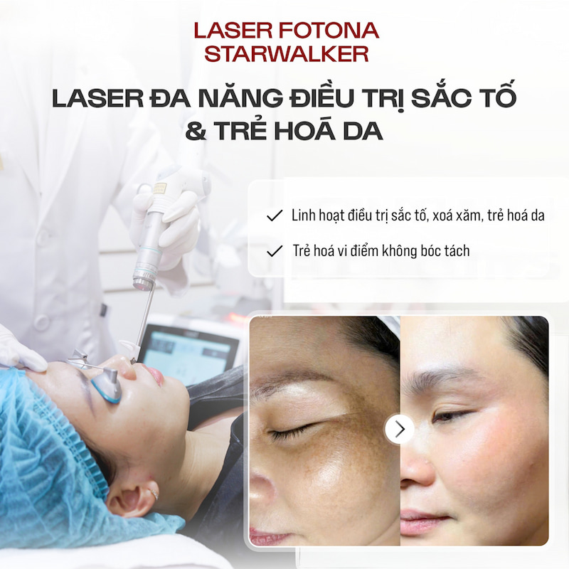 công nghệ Fotona StarWalker QX