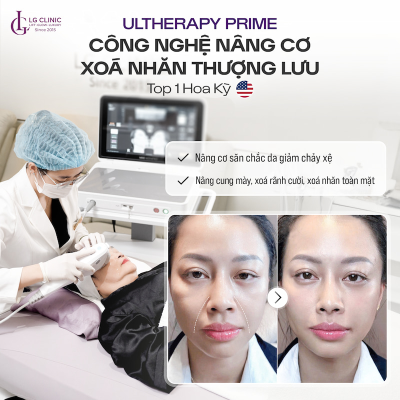 công nghệ nâng cơ ultherapy prime