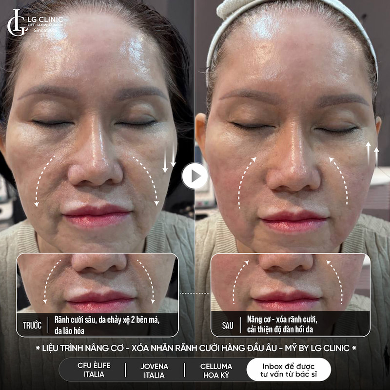 công nghệ tripple treatment