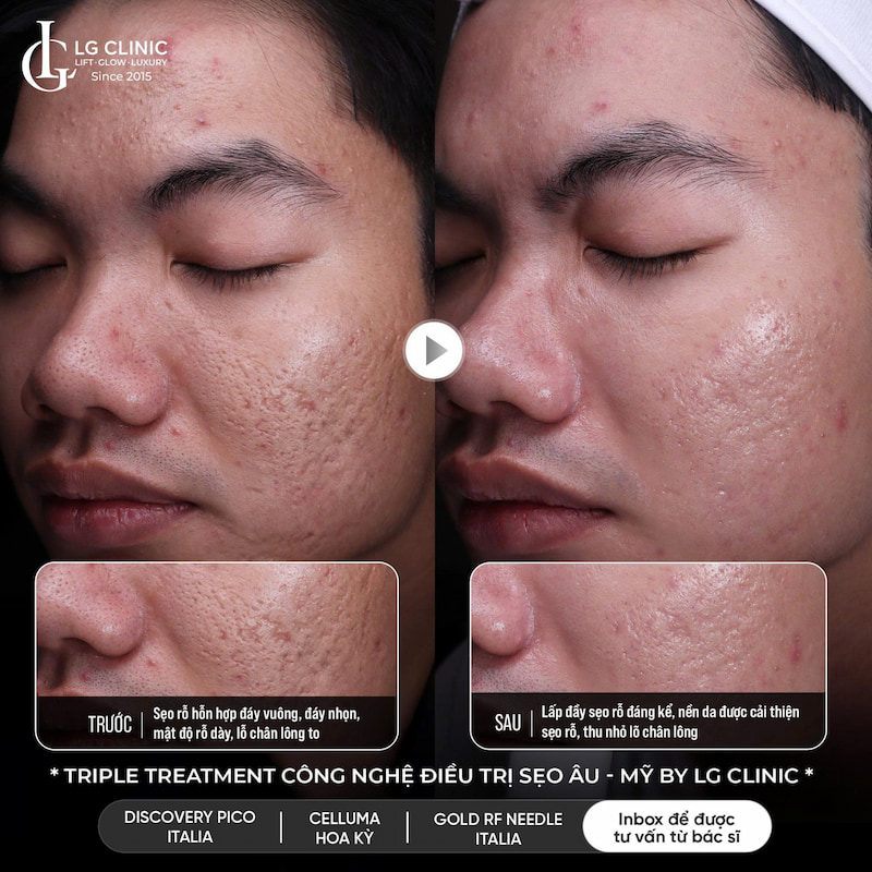 công nghệ tripple treatment