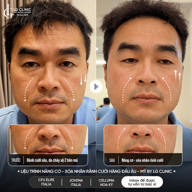 công nghệ tripple treatment