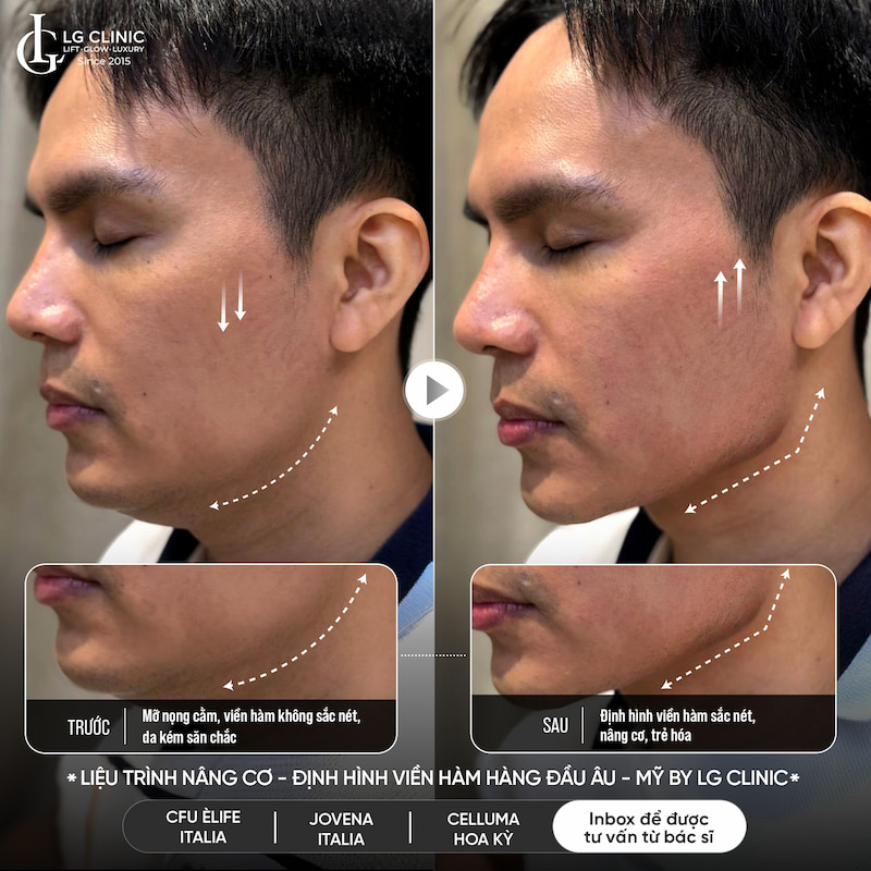 công nghệ tripple treatment