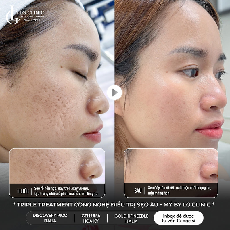 công nghệ tripple treatment